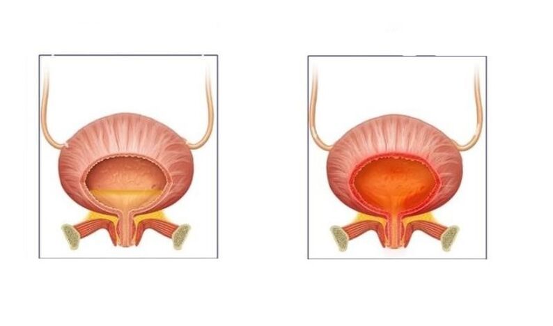 Normal e pacientes con infección da vexiga do tracto urinario