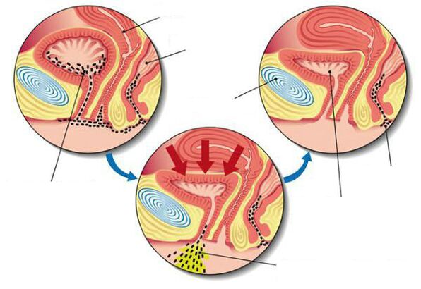 Bacterias na vexiga durante a cistite