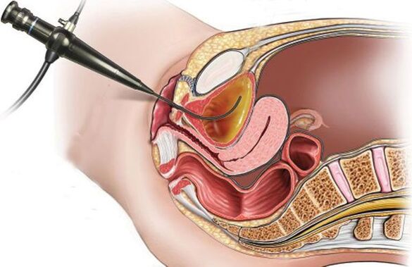 Cistoscopia para cistitis